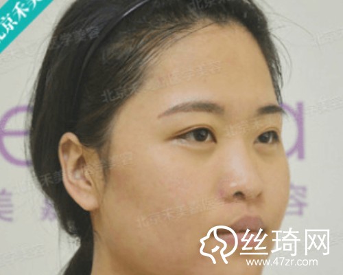 北京禾美嘉醫(yī)療美容自體脂肪填充面部那個(gè)醫(yī)生好？