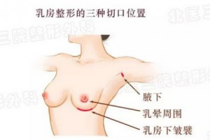 假體隆胸前，我需要做些什么?