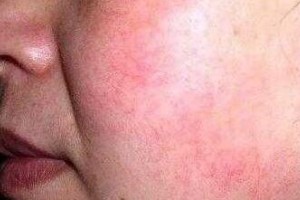 去紅血絲修護方法有哪些呢？