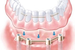 北京京一口腔：種植牙長壽的秘訣及種植牙護理方法有哪些