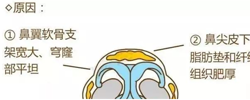 鼻尖肥大原因是什么及微創(chuàng)鼻頭縮小術(shù)適合人群是哪些