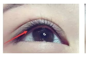 做美瞳線，疼不疼？半永.久美瞳線優(yōu)勢有哪些