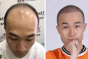 幾種治脫方式及治脫發(fā)較有的方法是什么