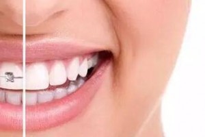 30歲后做牙齒矯正來得及嗎？做正畸會(huì)有什么危害？