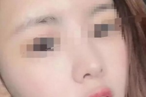 云南瑪麗亞整形美容醫(yī)院做的面部吸脂，原來擁有精致的小臉蛋這么簡單