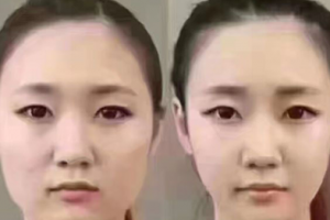 擁有精致小V臉？你只缺一支注射瘦臉注射瘦臉！