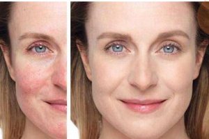 醫(yī)美護(hù)膚大課堂之如何祛紅祛痘印