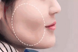 麗都自體脂肪移植，你值得擁有