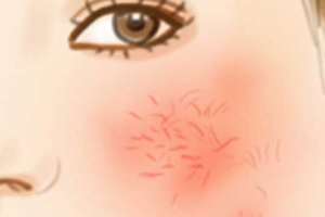 要怎么擺脫紅血絲？臉上有紅血絲的成因時(shí)什么