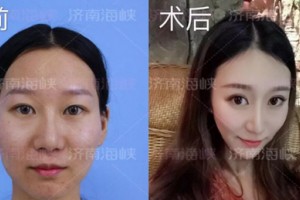 濟南海峽整形自體脂肪填充：取“脂”于你，用“脂”于你!