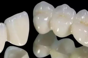 全瓷牙就是烤瓷牙？兩者有差別嗎？該怎么選擇？