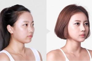 面部填充需要填充哪些地方比較好