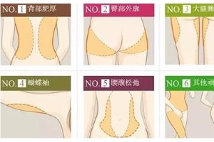 上海天大整形醫(yī)院吸脂果好嗎?上海吸脂減肥要多少錢？