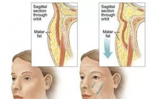 在韓國做去眼袋手術(shù)如何？純真眼底脂肪重排術(shù)價(jià)格曝光