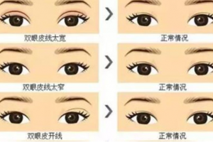 割了雙眼皮真的能提升你的顏值嗎