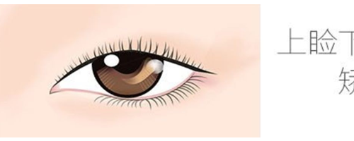上瞼下垂矯正原理是是什么，上瞼下垂問題應(yīng)該如何矯正？