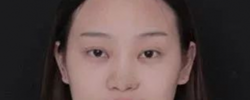 北京鼻部手術(shù)價格和鼻部手術(shù)術(shù)后1-7天的照片