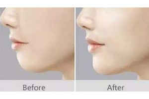 自體脂肪填下巴優(yōu)缺點(diǎn)對比及術(shù)后注意事項(xiàng)