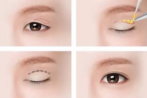 上瞼皮膚松弛矯正費用多少錢