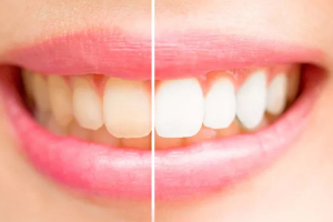 牙齒冷光美白的副作用