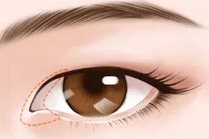 北京開眼角一般花費多少錢