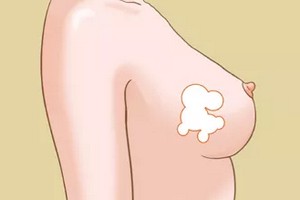 自體脂肪隆胸的果怎么樣