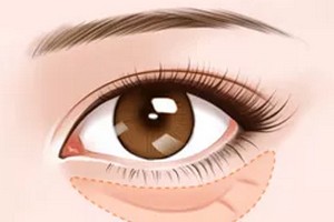 眼袋失敗可以修復(fù)嗎