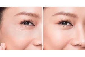 注射除魚尾紋需要多少錢