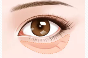 去眼袋手術(shù)后遺癥有哪些