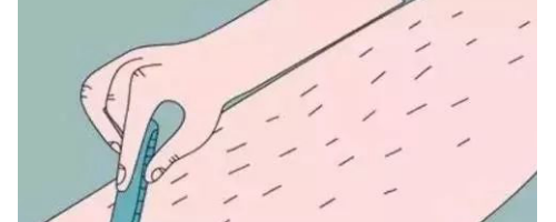 什么是激光脫毛?