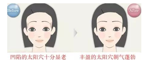 晶馨SG自體脂肪細胞豐太陽穴，秒變V臉女神不是夢！