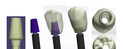 來自美國牙齒種植修復高端技術：DOSA