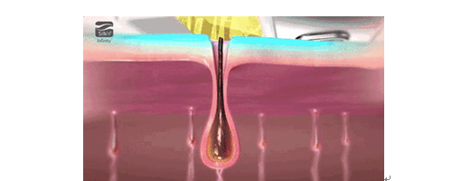 美萊妍學社做過激光脫毛的你，對它真的了解嗎？