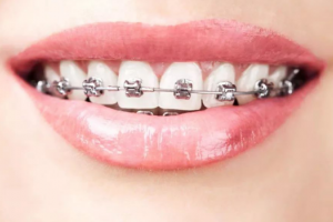 牙齒矯正需要做哪些檢查呢?