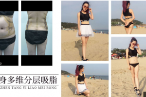 一個疑思，吸脂減肥真的有用嗎？