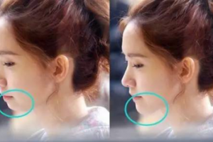 有了下巴，人都美了！面部有輪廓了，氣質(zhì)更好了！