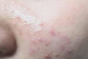 調(diào)節(jié)痘痘為什么不能依靠美容院，化妝品？