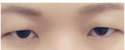 【普賽克】矯正上瞼下垂，get美眼