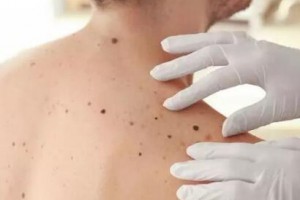 激光激光祛痣，還你肌膚“清白”！