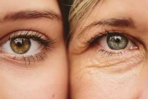 激光去眼袋的優(yōu)點是什么？激光去眼袋有哪些注意事項?