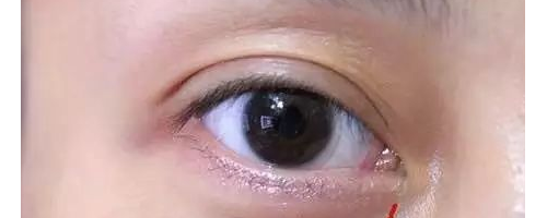 為啥？你做了去眼袋手術(shù)后，又復(fù)發(fā)了呢？