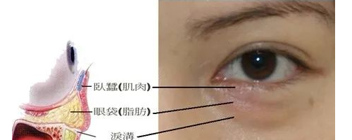 你們可能不知道，淚溝比眼袋丑多了