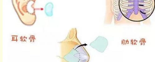 [普及]自體軟骨隆鼻？軟骨來自身體哪個部位呢？