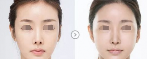 發(fā)際線后退？一招幫你解決！