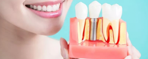 花了上萬(wàn)塊的種植牙，怎么護(hù)理才能更耐用呢？