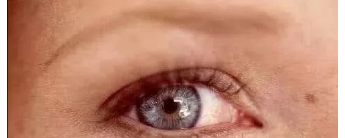 黃褐斑為什么愛反復(fù)？醫(yī)學(xué)博士：祛斑3大金方，排黑素，去褐斑！