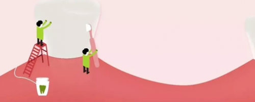 家人不用擔(dān)心我的胃口了！牙齒種植Soeasy！