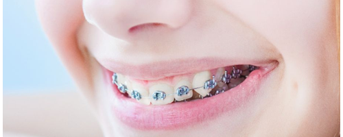 為什么牙齒矯正那么貴？