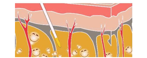 吸脂瘦大腿會反彈嗎?吸脂瘦大腿果維持多久?