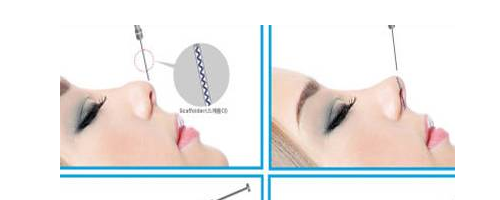 隆鼻要取代假體？感覺有點(diǎn)兒扯